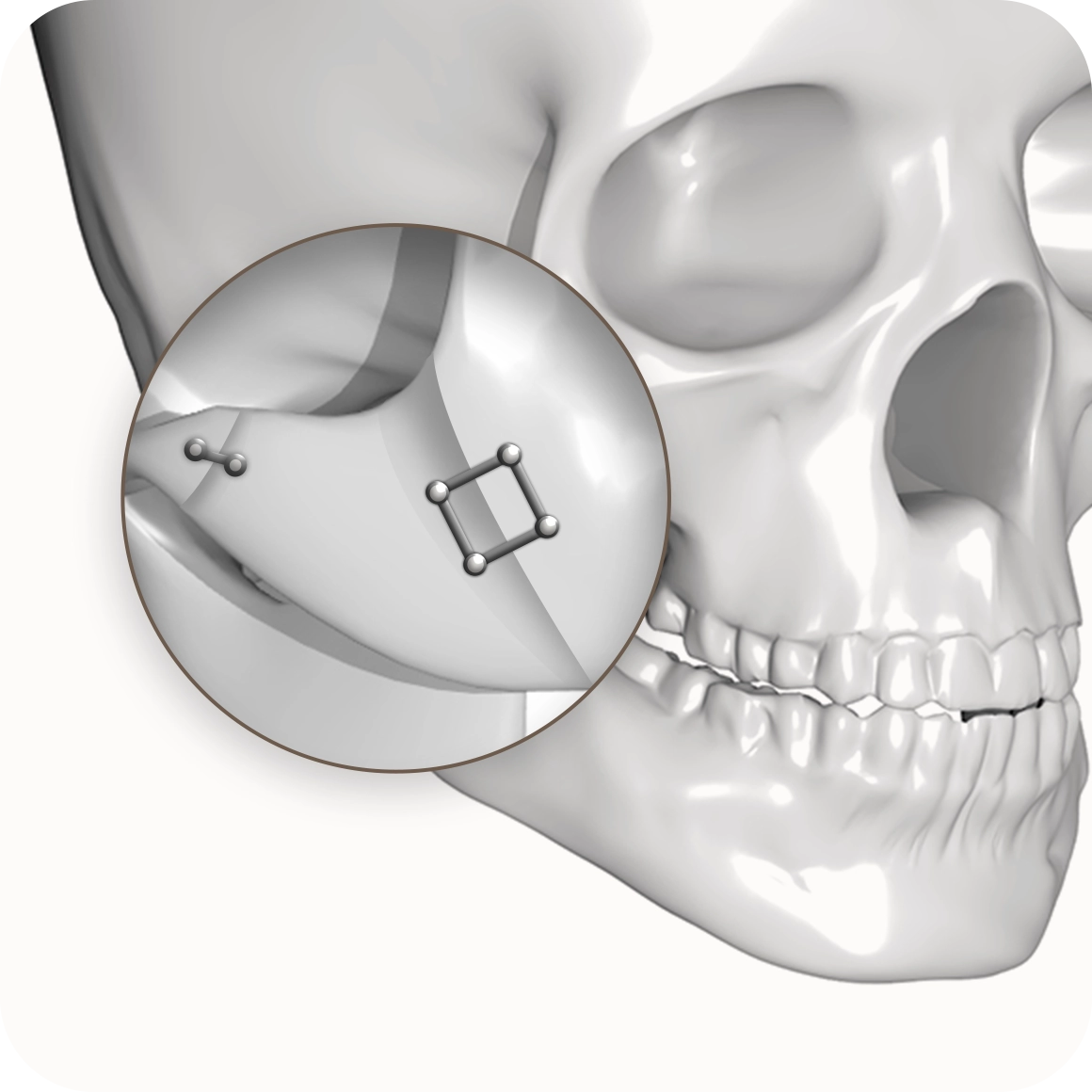 Skull showing zygomaticomaxillary fixation for 345 plastic surgery where natural