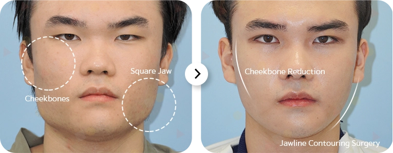 Plastic surgery before and after showing cheekbone reduction and jawline contouring for a natural look. 345 Plastic Surgery.