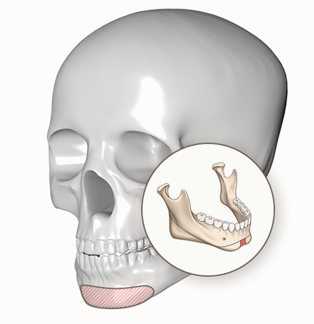 Skull illustration with jawline for 345 plastic surgery where natural. Jaw bone augmentation for natural plastic surgery.
