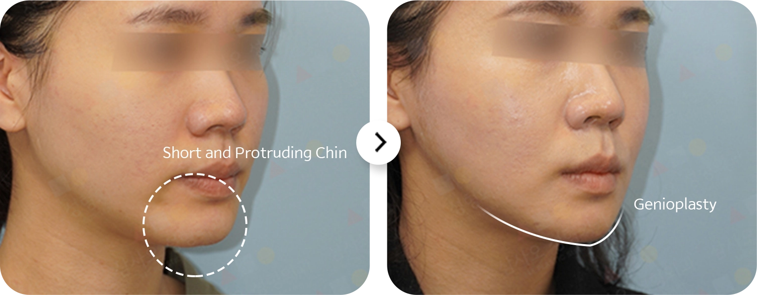 Plastic Surgery 345: Before and after genioplasty for a natural chin. Chin augmentation reshapes a short protruding chin.