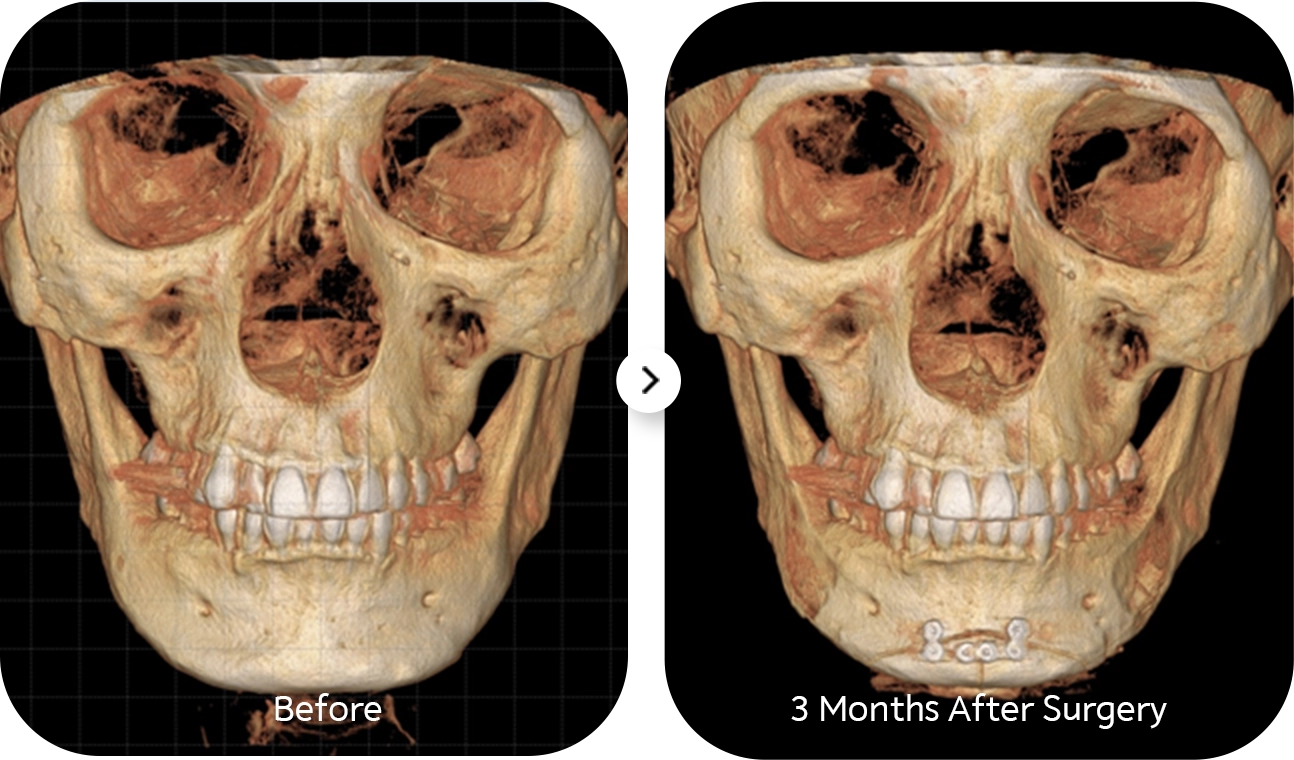 3D CT scan showing before and after 345 plastic surgery results. Natural plastic surgery.