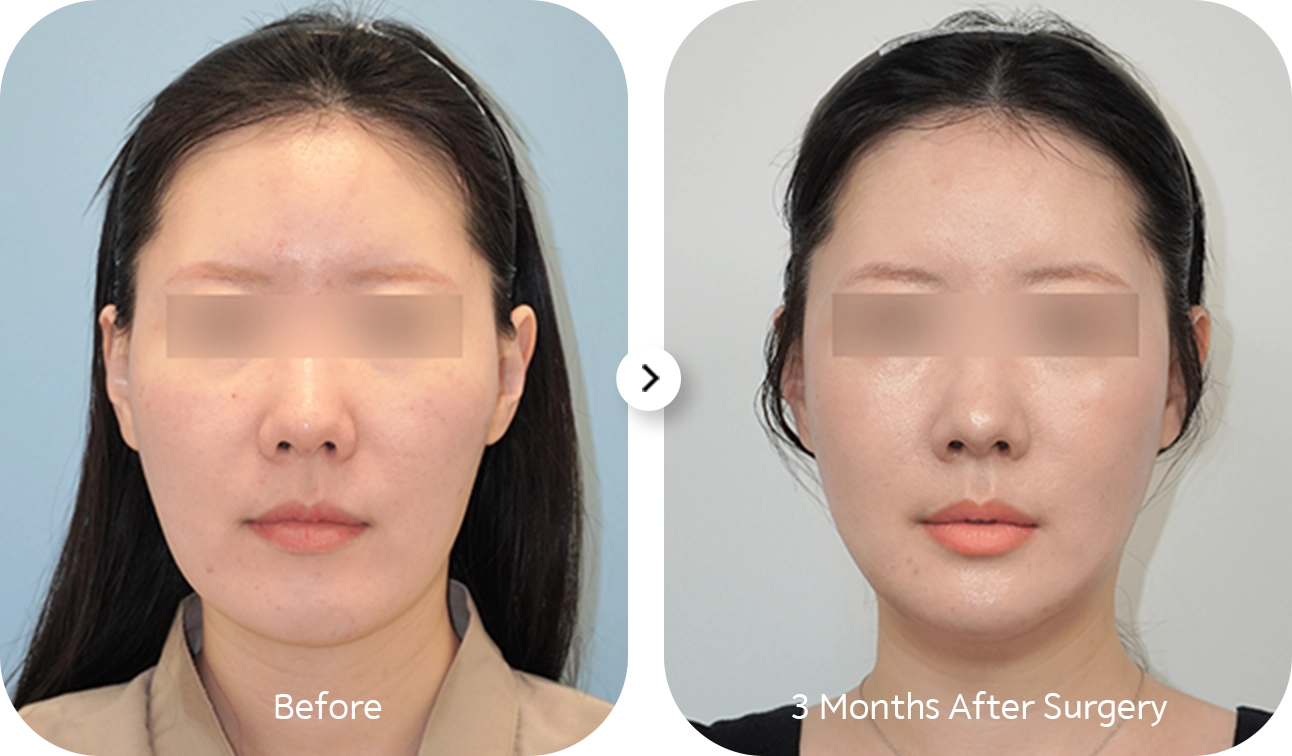 Before and after 345 plastic surgery for natural results. Woman's face showing changes after plastic surgery.
