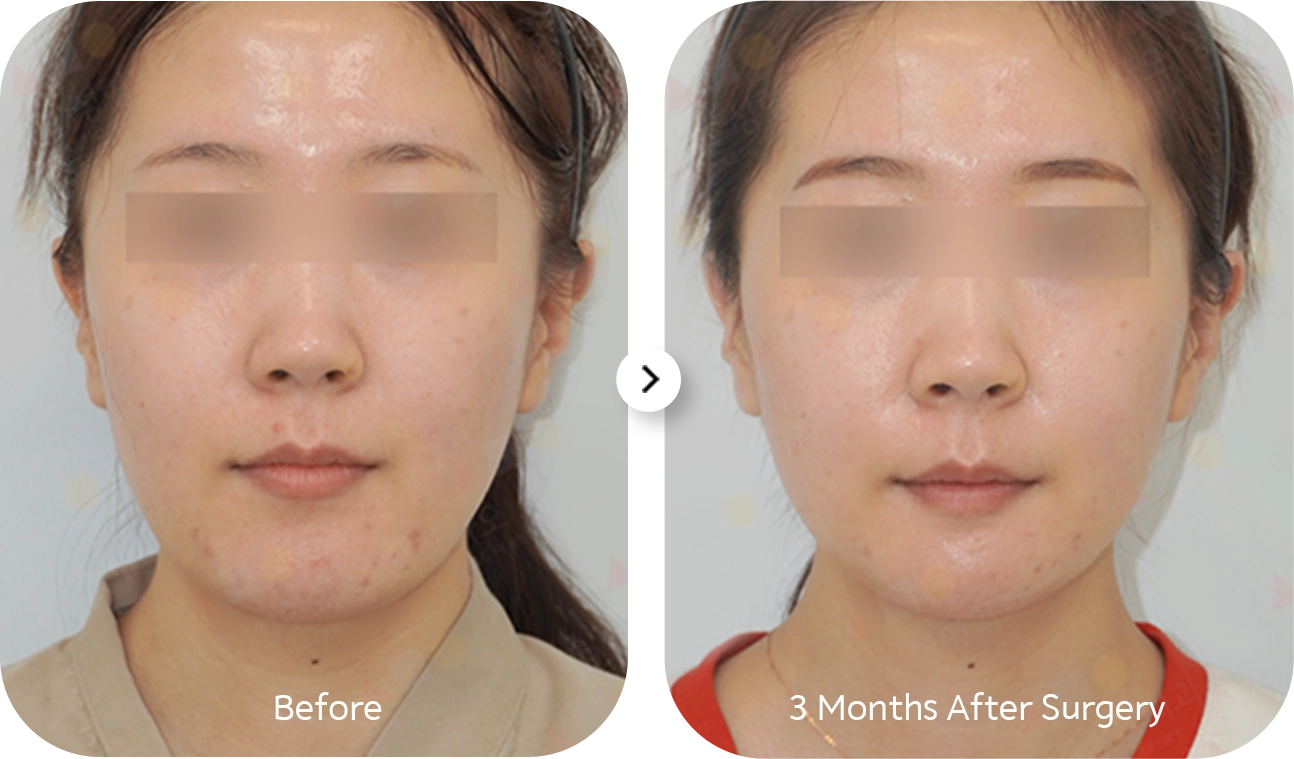 345 Plastic Surgery before and after. Face shows natural surgery results.