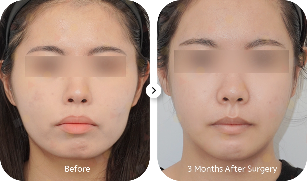 Before and after 345 plastic surgery where natural. Face contouring plastic surgery results.