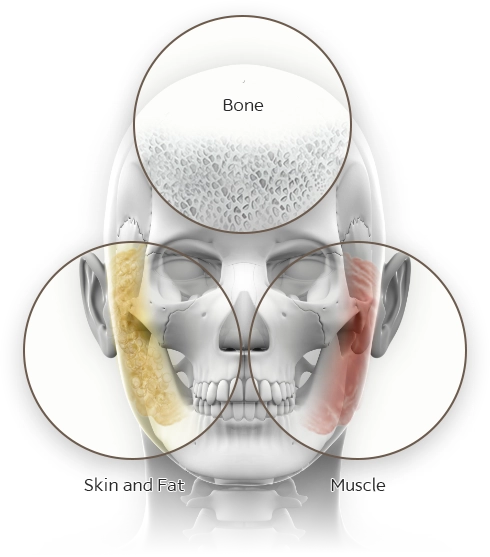 Facial bone structure diagram for plastic surgery. Bone, skin, fat, muscle. 345 Plastic Surgery where natural.