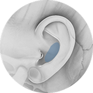 Ear with blue filler for 345 plastic surgery where natural cosmetic procedure.