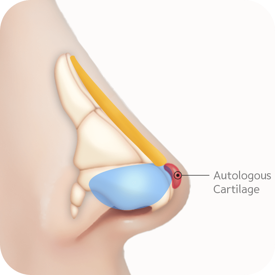 Autologous cartilage graft in 345 plastic surgery for natural rhinoplasty. Nose augmentation and tip refinement.
