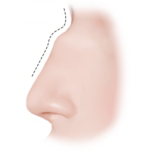 Rhinoplasty diagram for natural 345 plastic surgery nose job.