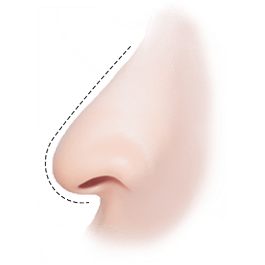 Plastic surgery rhinoplasty nose job illustration for natural 345 results.