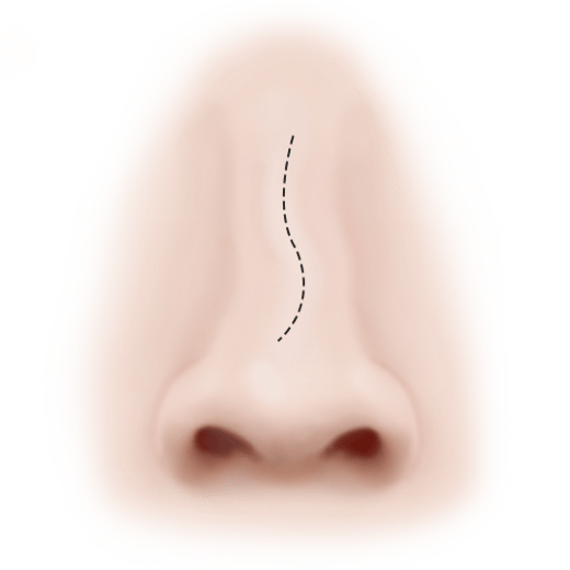 Nose with dotted line for 345 plastic surgery where natural rhinoplasty incision.
