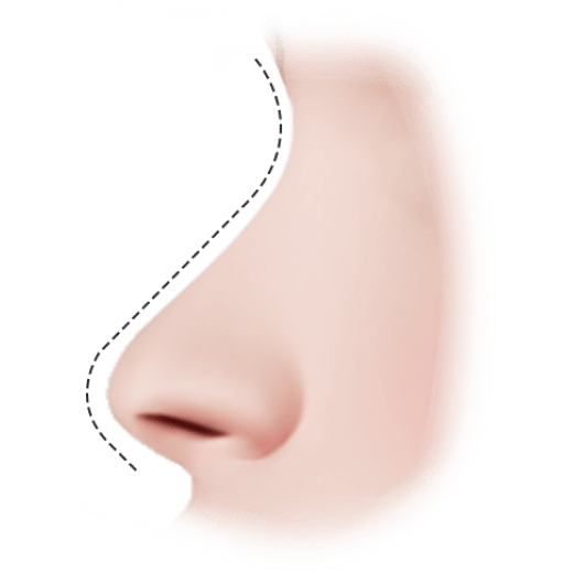 345 Plastic Surgery for natural results: Nose profile with dotted line for surgical planning.