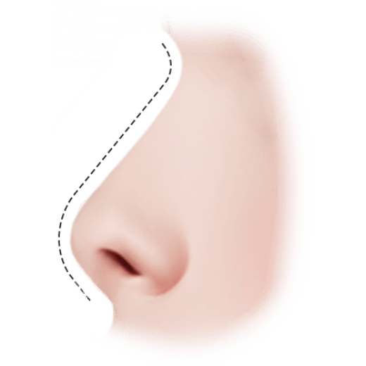 345 Plastic surgery nose contouring for natural results. Rhinoplasty procedure.