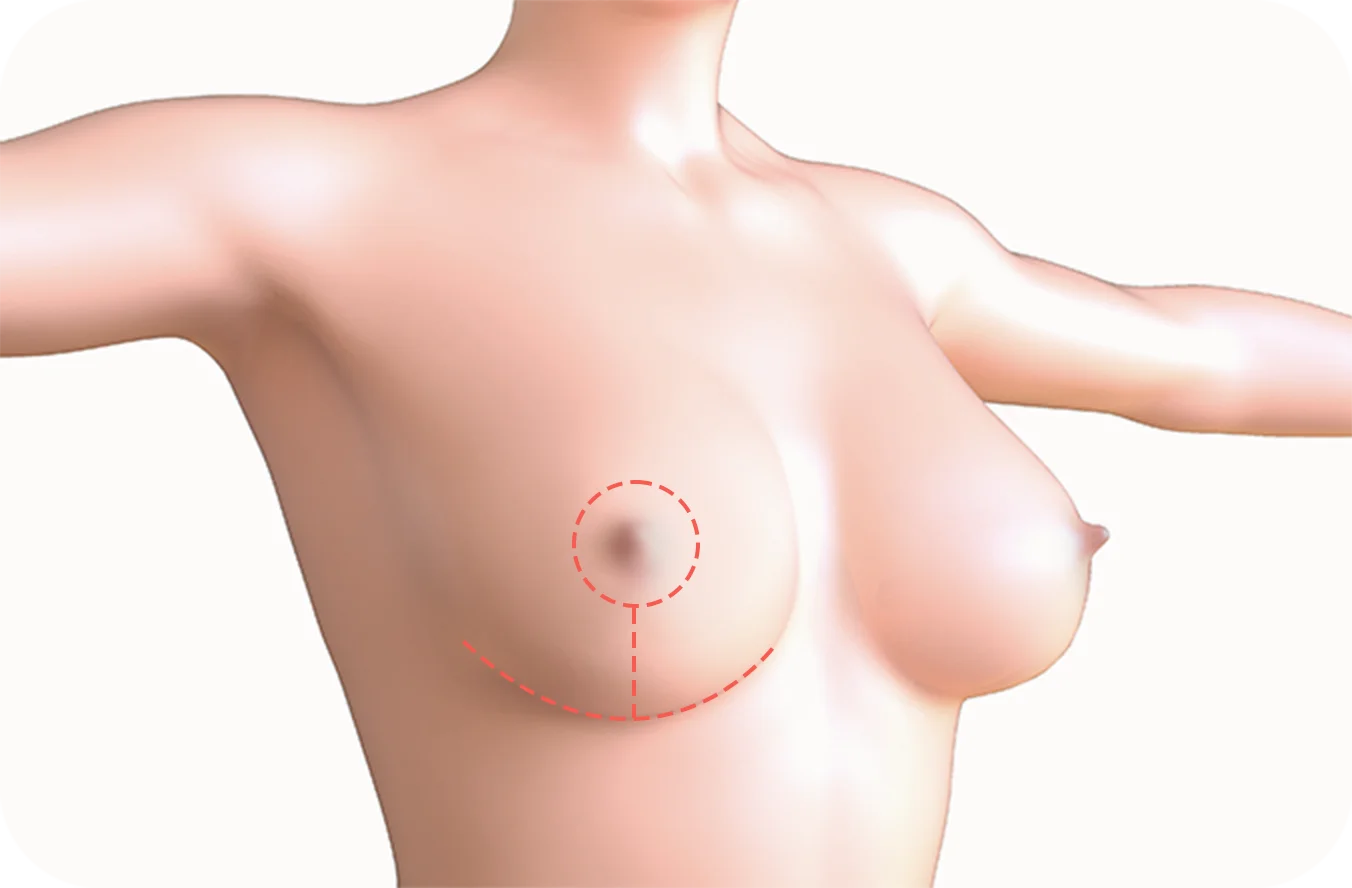 Breast lift diagram for plastic surgery where natural is the goal 345.