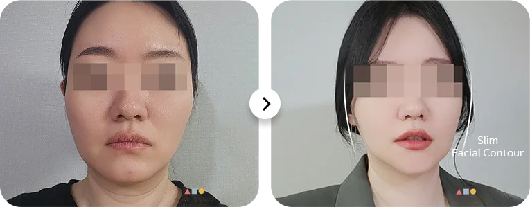 Facial contouring plastic surgery before and after. 345 Plastic Surgery where natural.