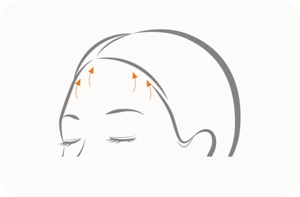 Forehead lift diagram for natural looking 345 plastic surgery.