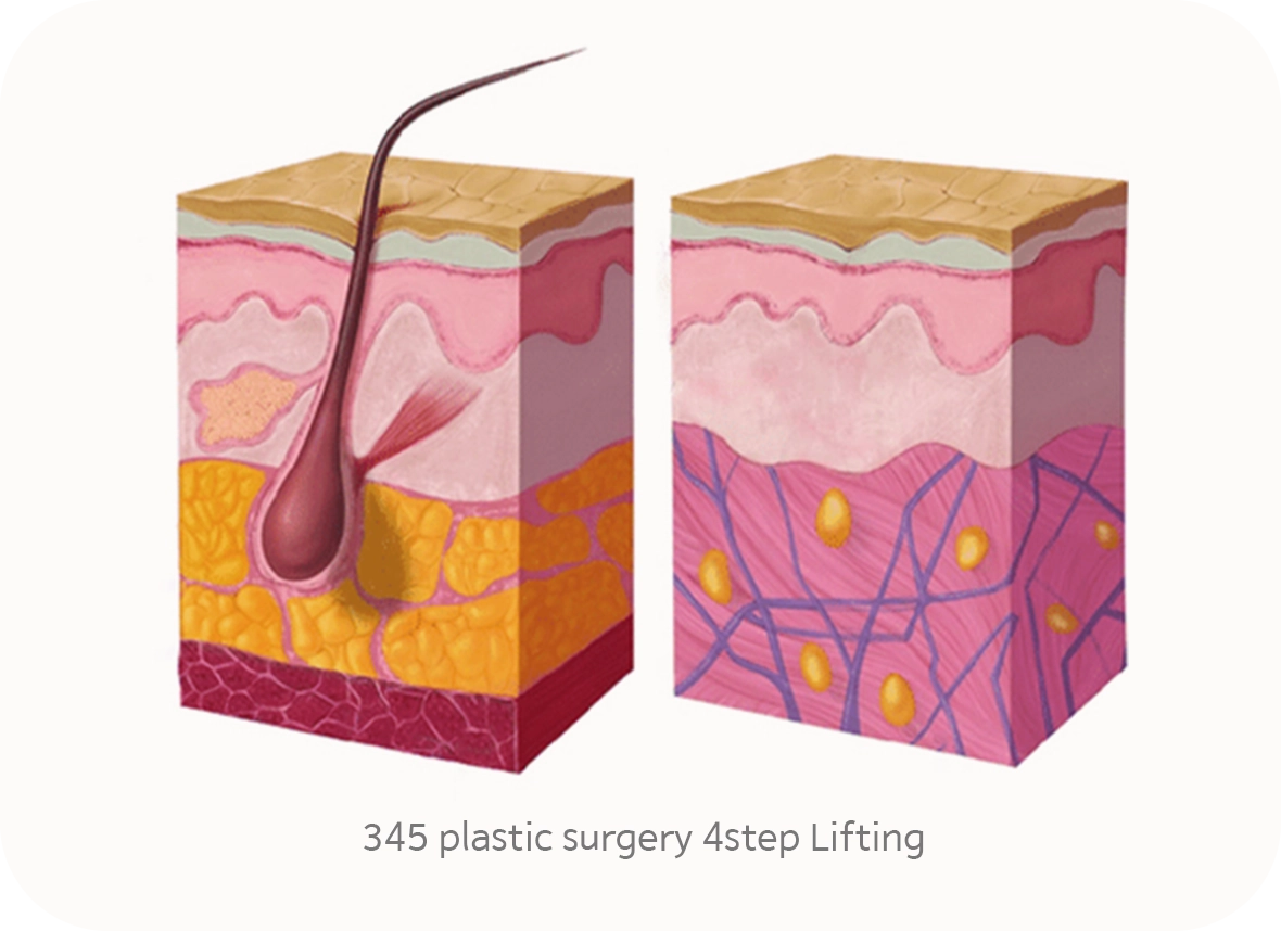 Skin layers before and after 345 plastic surgery. Natural results from plastic surgery.