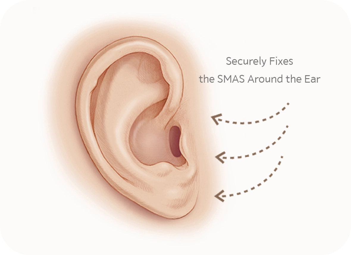 Ear SMAS fixation diagram for 345 plastic surgery where natural results are achieved