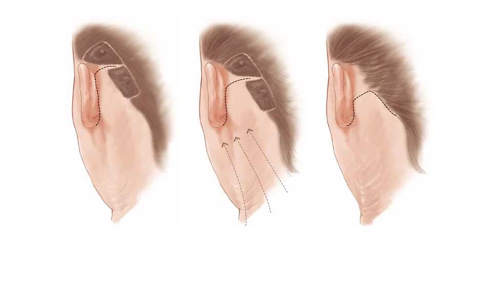 345 Plastic Surgery for natural facelift. Illustration of face lift procedure.