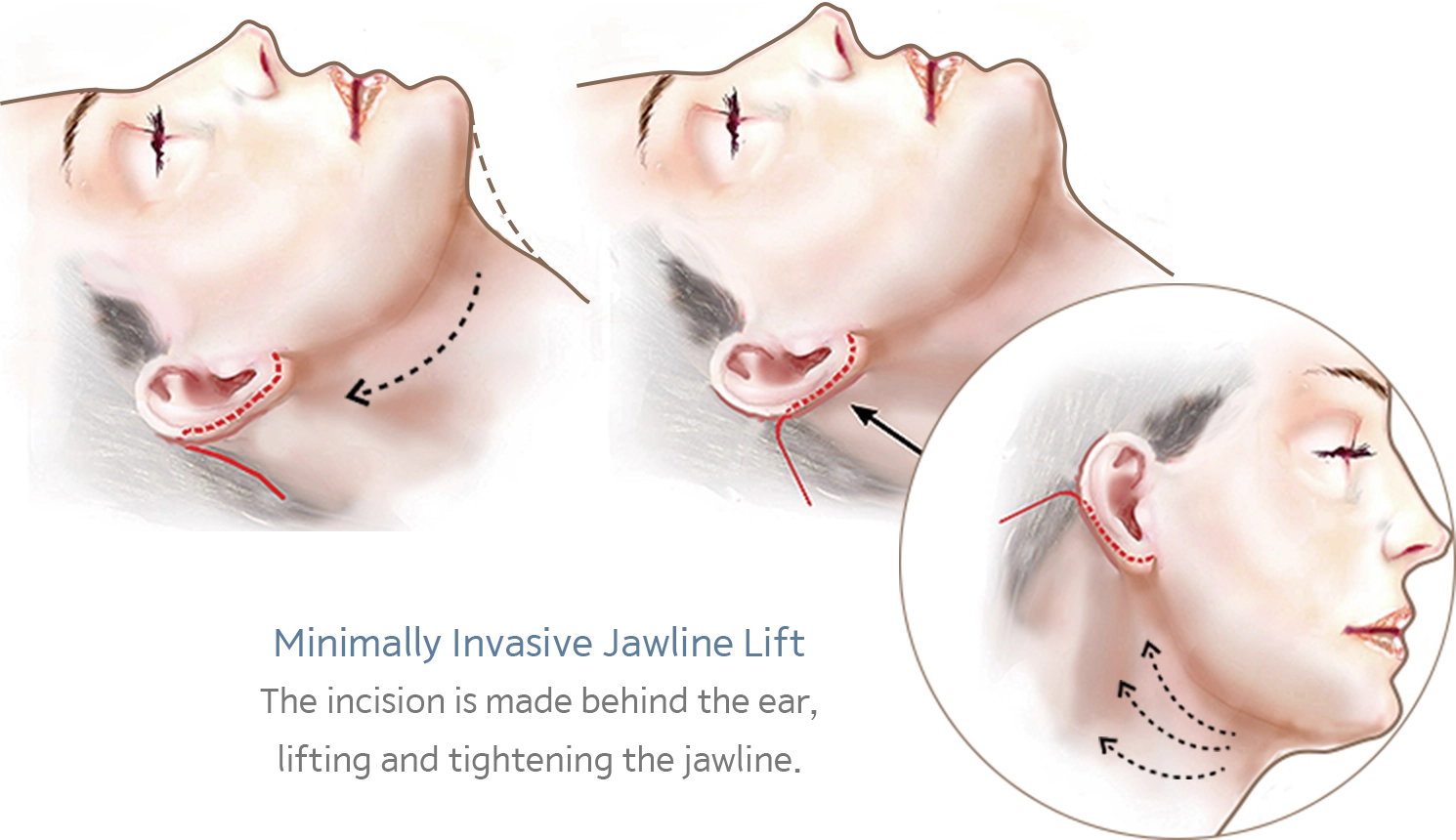 Jawline lift diagram showing incisions for 345 plastic surgery where natural.