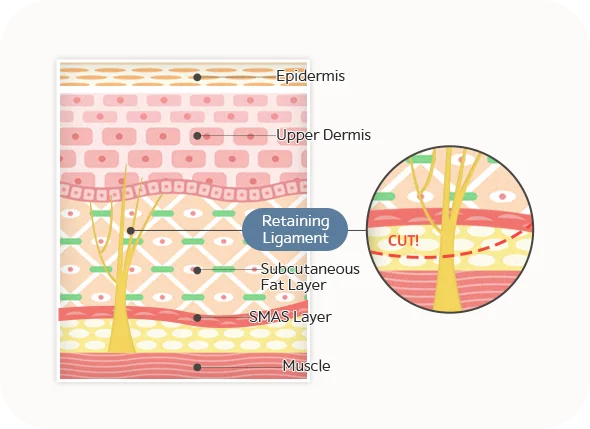 Diagram of skin layers for 345 plastic surgery where natural, showing epidermis, dermis, fat, SMAS, muscle, and retaining ligament.