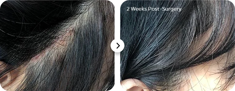 Hairline after plastic surgery 2 weeks post-op. 345 Plastic Surgery where natural results.