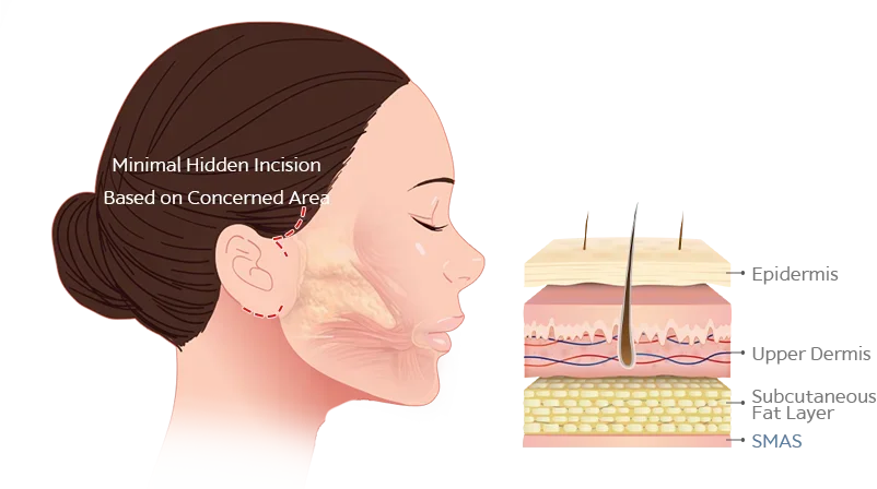 345 Plastic Surgery face lift diagram showing minimal incision for natural results