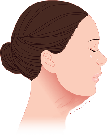 Woman with neck wrinkles for 345 Plastic Surgery where natural results.