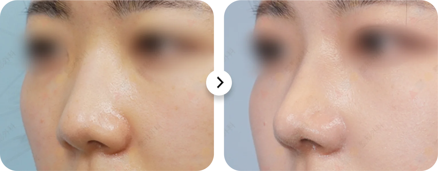 Rhinoplasty before and after. 345 Plastic Surgery where natural nose job.