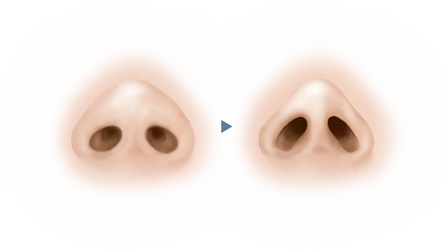 345 Plastic Surgery for natural results, showing before and after nose rhinoplasty.