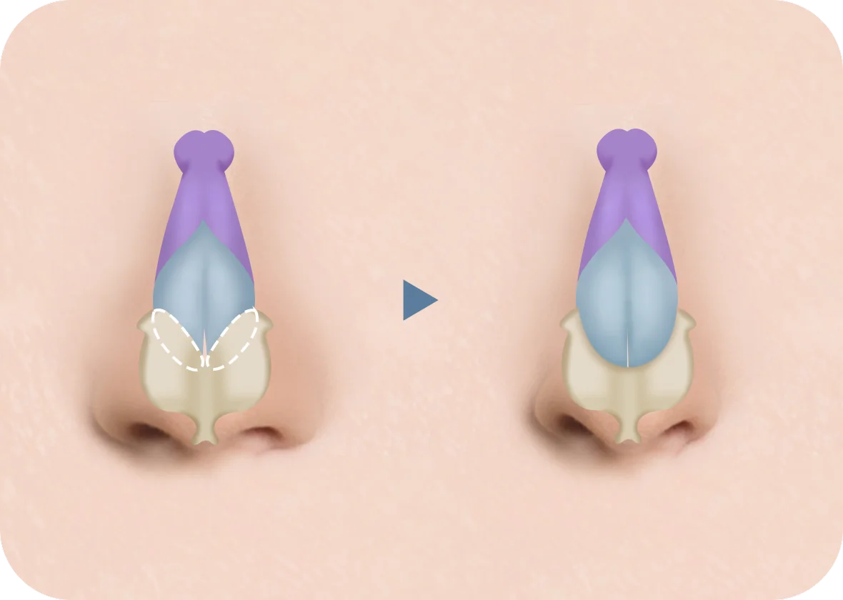 345 Plastic Surgery diagram showing natural nose reshaping. Before and after rhinoplasty.