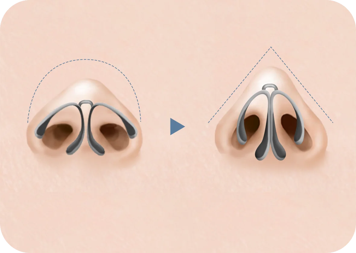 345 Plastic Surgery for natural nose shape. Before and after rhinoplasty illustration.