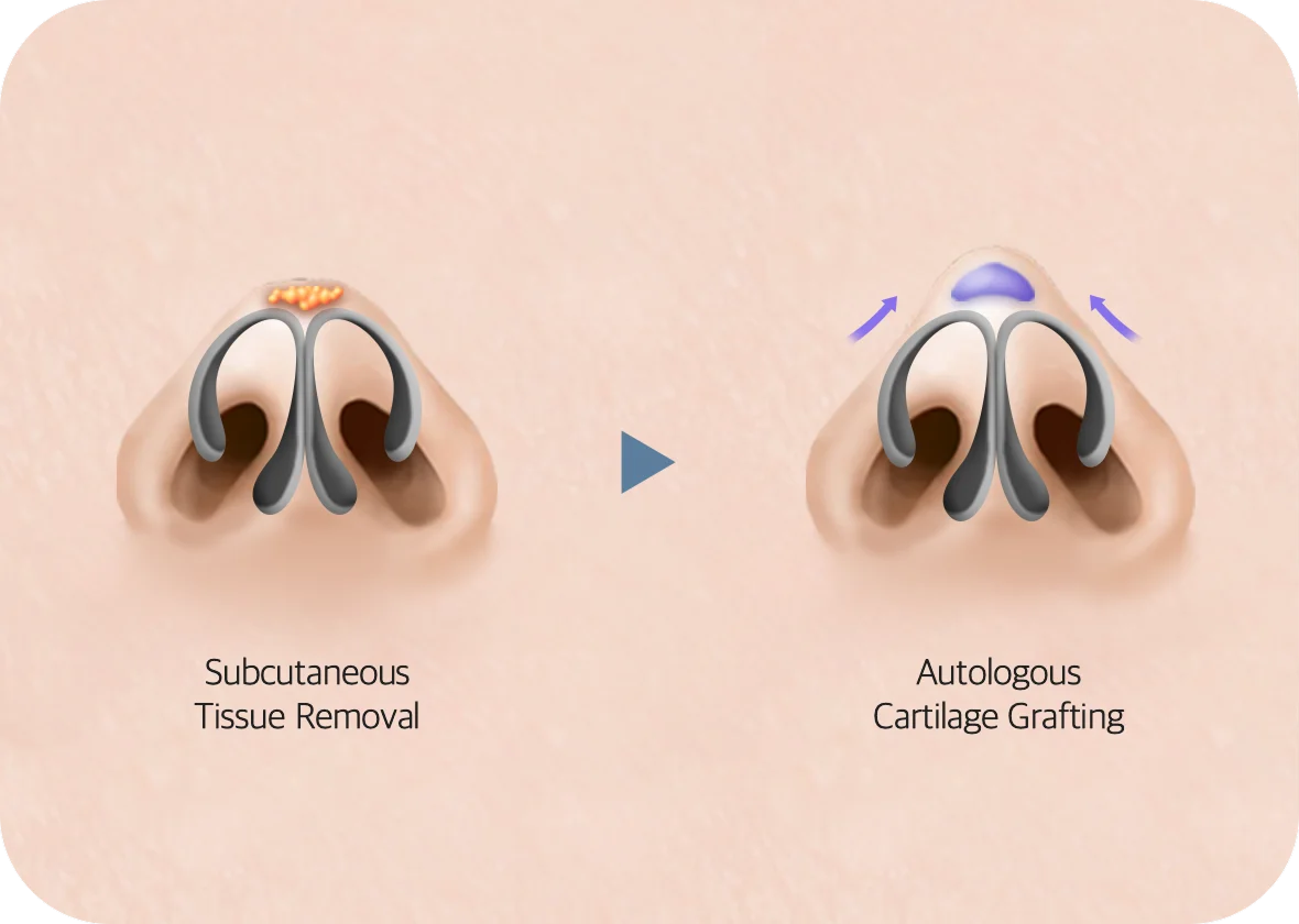 Plastic surgery nose job showing cartilage grafting for natural 345 results