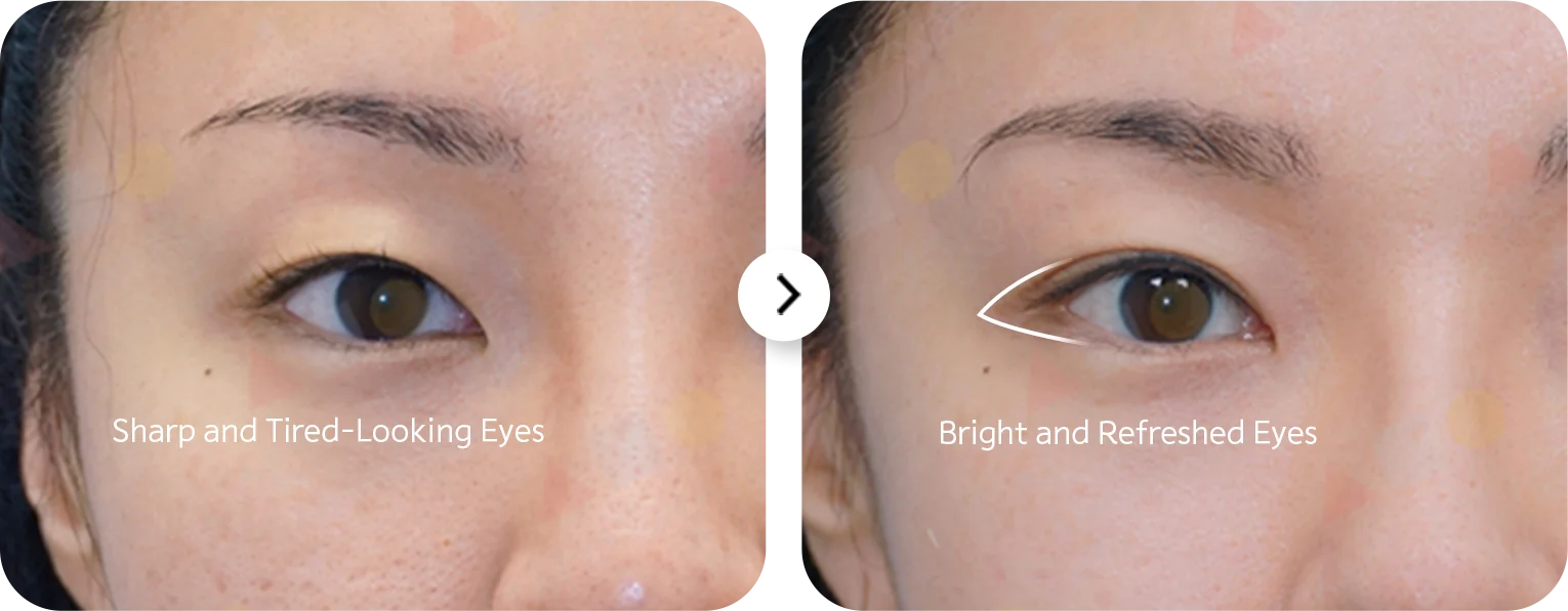 Asian eyes before and after 345 plastic surgery where natural looking bright refreshed eyes tired looking eyes.