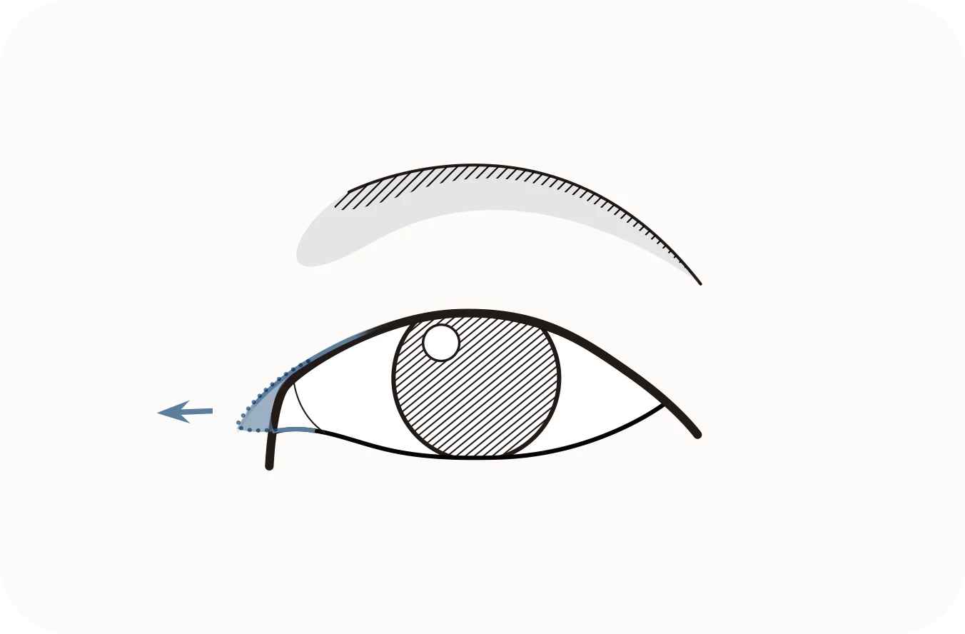 Eyelid plastic surgery diagram for natural 345 plastic surgery results