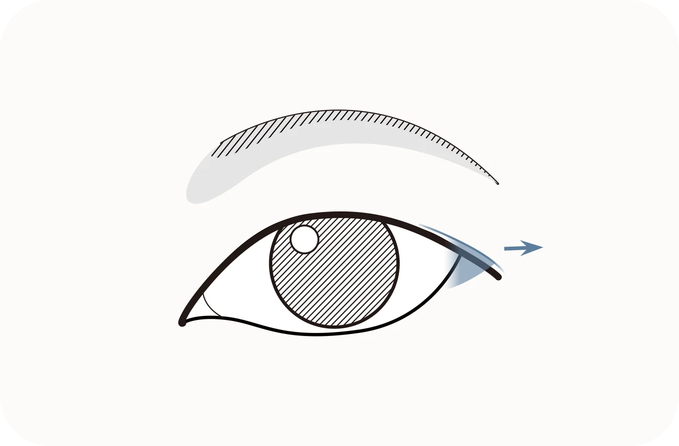 Eyelid lift diagram for plastic surgery. Natural results with blepharoplasty. 345 Plastic Surgery.