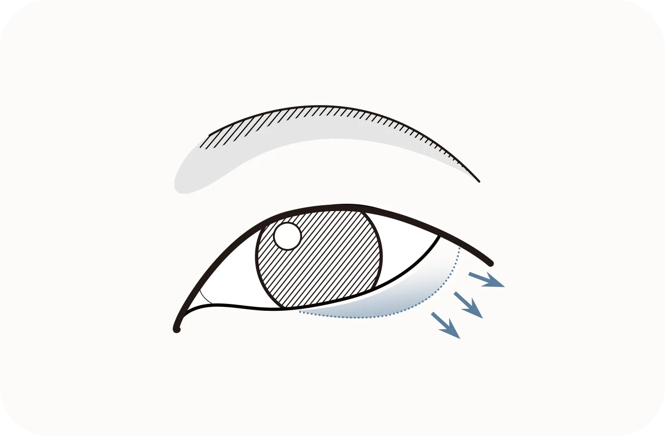 Eye bag removal diagram for natural 345 plastic surgery.