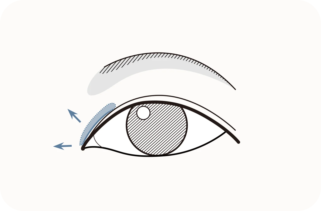 Eyelid diagram for 345 plastic surgery where natural results are achieved.
