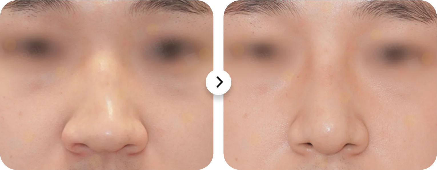 Before and after 345 plastic surgery nose job where natural. Rhinoplasty results.