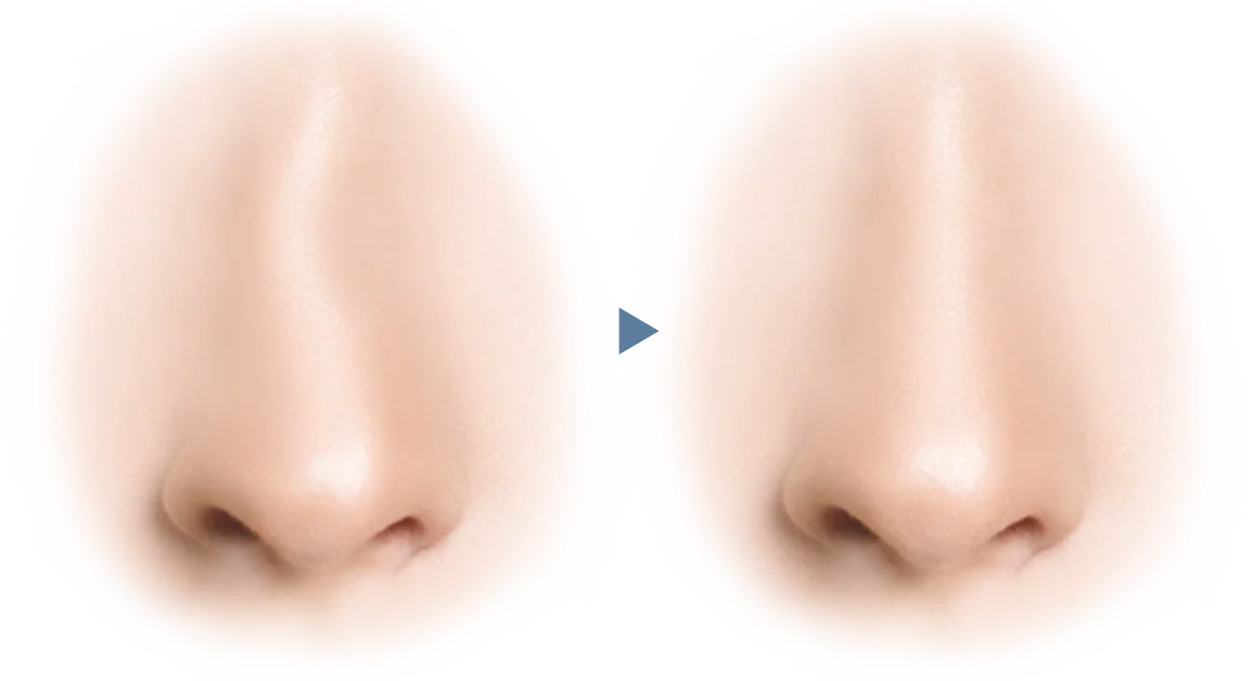 Nose before and after 345 plastic surgery where natural, showing subtle rhinoplasty results.