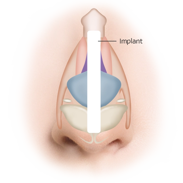 Nose implant diagram for 345 plastic surgery where natural results are desired.