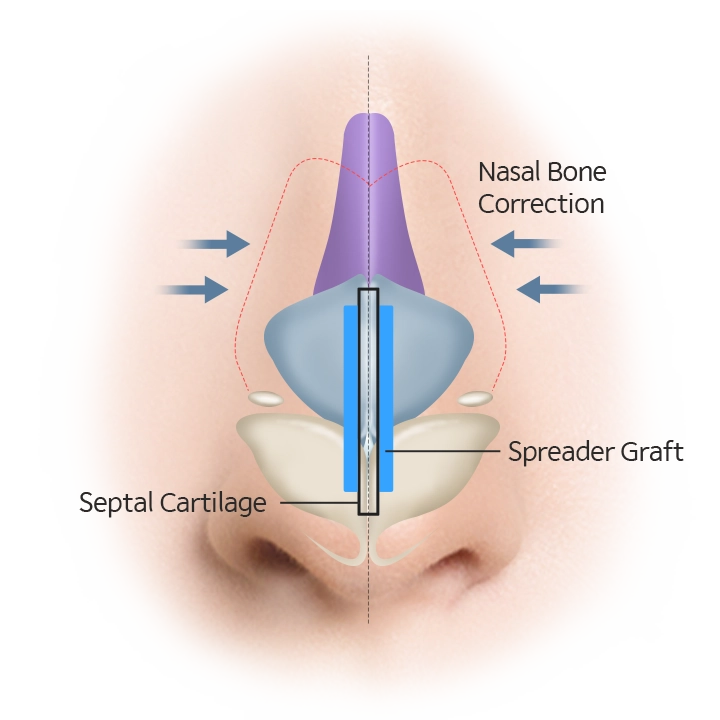 Nasal bone correction diagram for 345 plastic surgery where natural, septal cartilage and spreader graft.