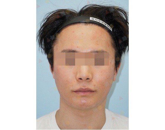 Man before 345 plastic surgery. Natural results from plastic surgery.