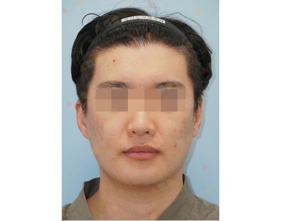 Asian man with headband for 345 plastic surgery where natural
