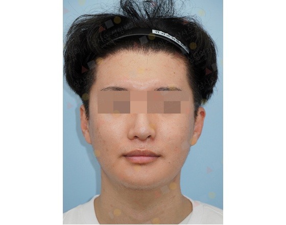 Asian male face, before 345 Plastic Surgery where natural, showing pre-op skin condition.