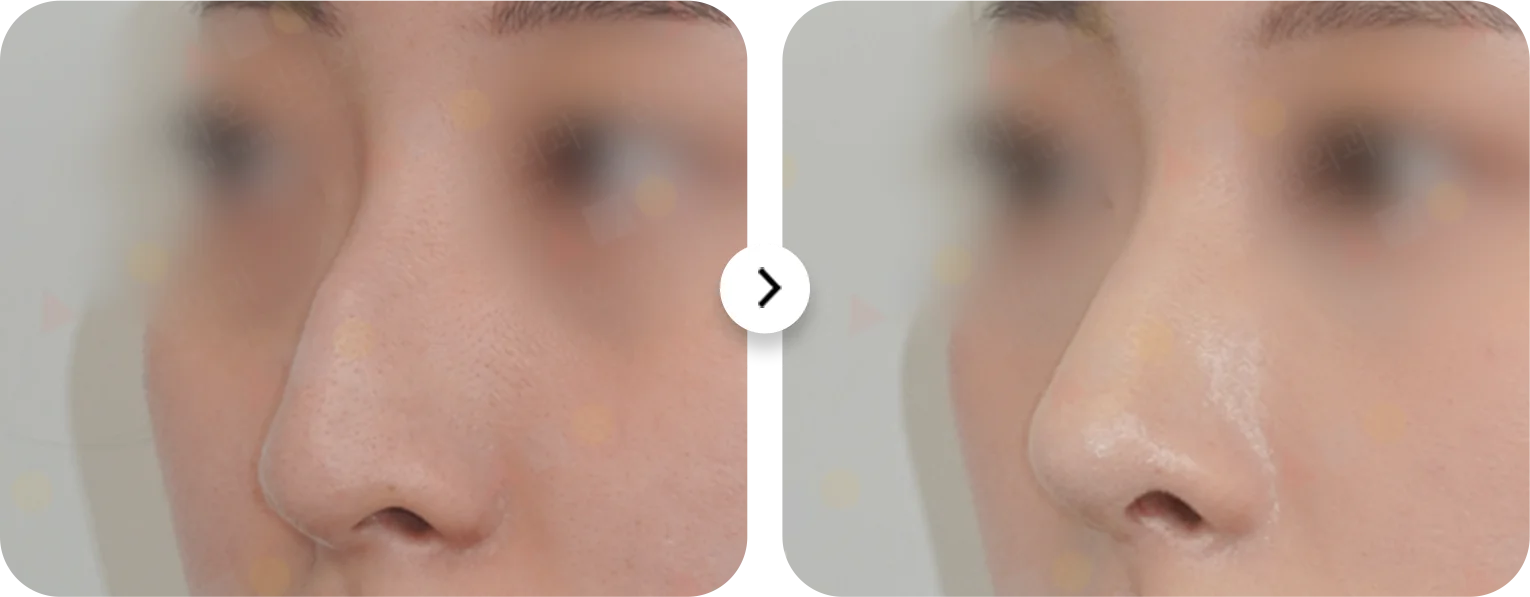 Rhinoplasty before and after. Nose plastic surgery for natural 345 results.