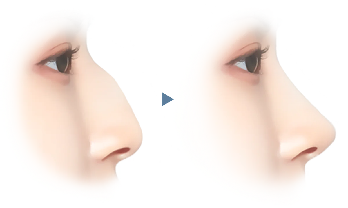 Rhinoplasty before and after showing 345 plastic surgery results where natural.