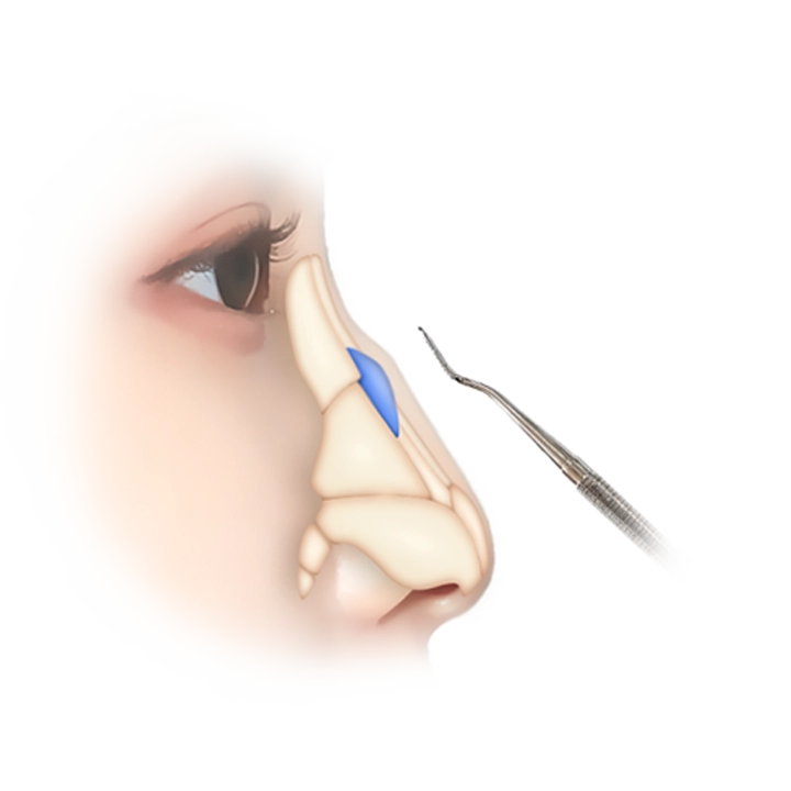 Nose plastic surgery diagram showing natural 345 plastic surgery procedure.