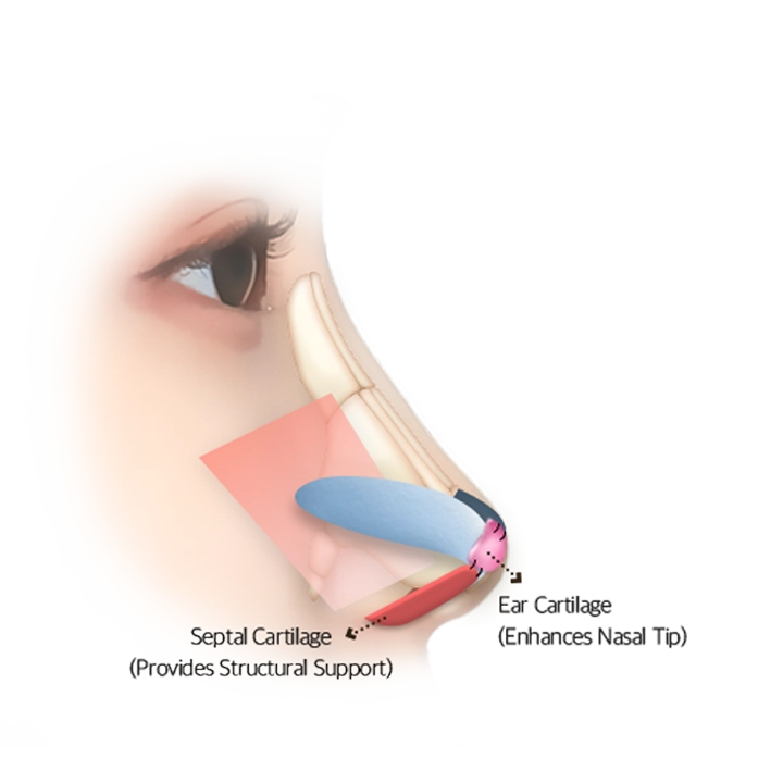 345 Plastic Surgery diagram of septal and ear cartilage for natural nose reshaping.