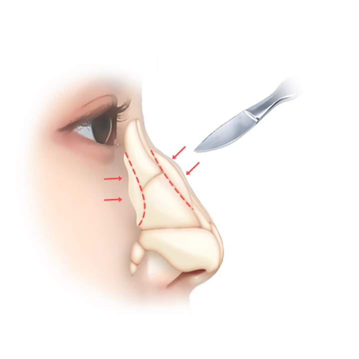 Plastic surgery diagram of rhinoplasty for natural results 345 plastic surgery.