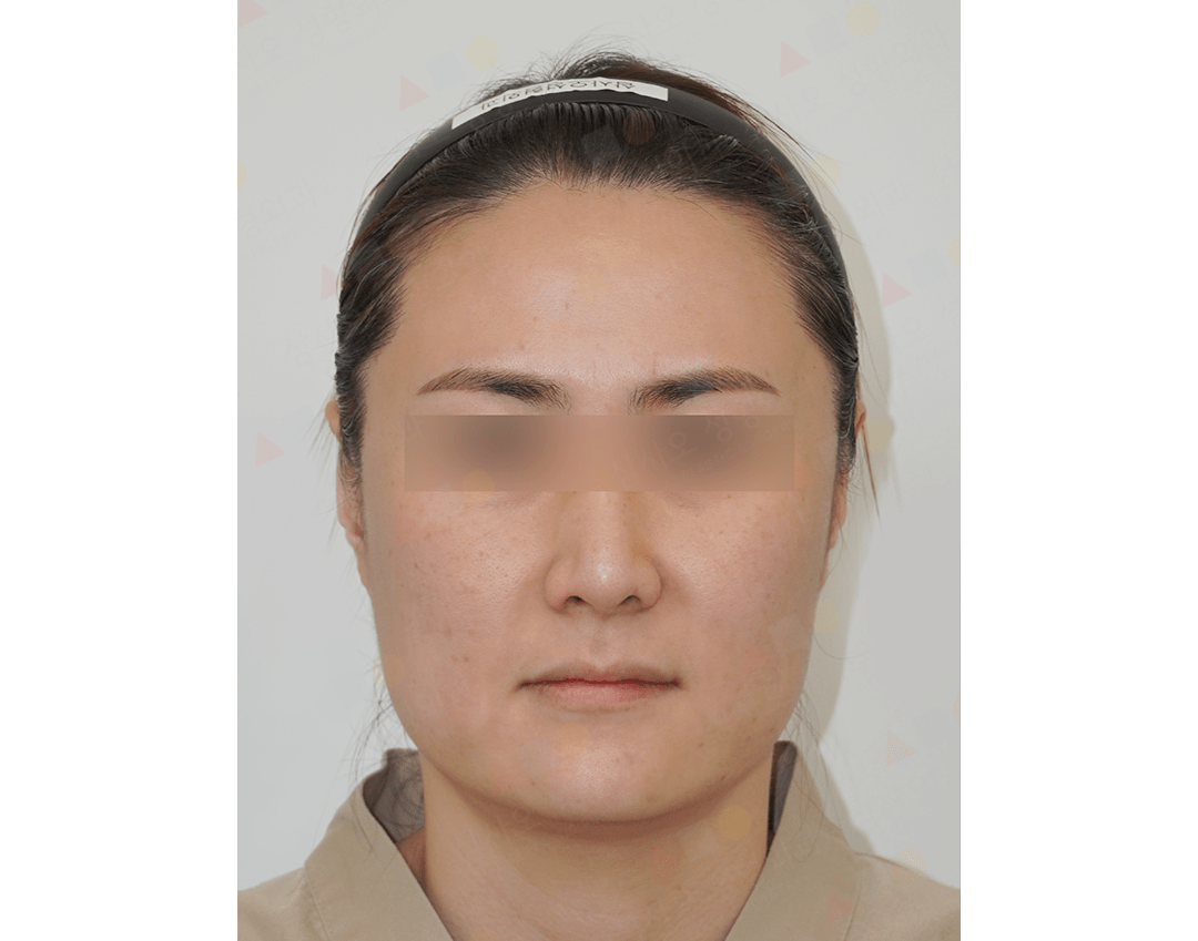 Asian woman before 345 plastic surgery where natural face view.